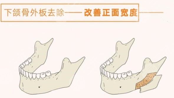 磨下颌角手术过程图恢复记录，真人下颌角磨骨对比图~