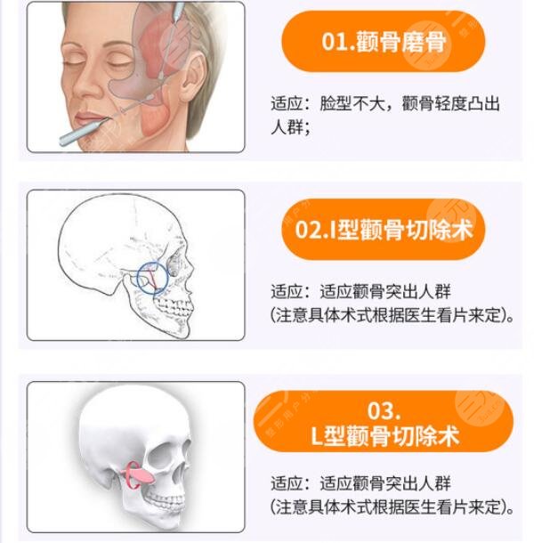 磨骨改脸型