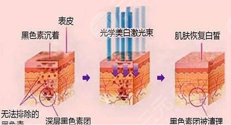 深蓝射频和光子嫩肤哪个好?