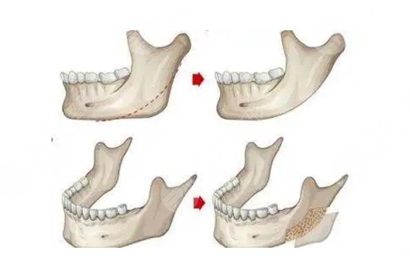 磨骨手术有什么风险和后遗症