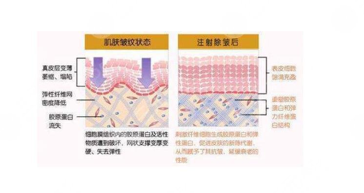 注射胶原蛋白能维持多长时间?