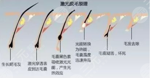 冰点脱毛和激光脱毛哪个果好？原理深扒！附价格一览2024