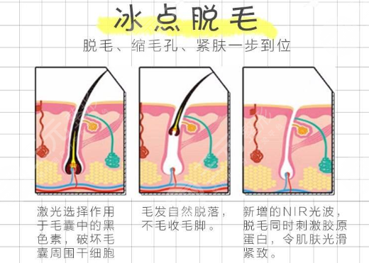 冰点脱毛