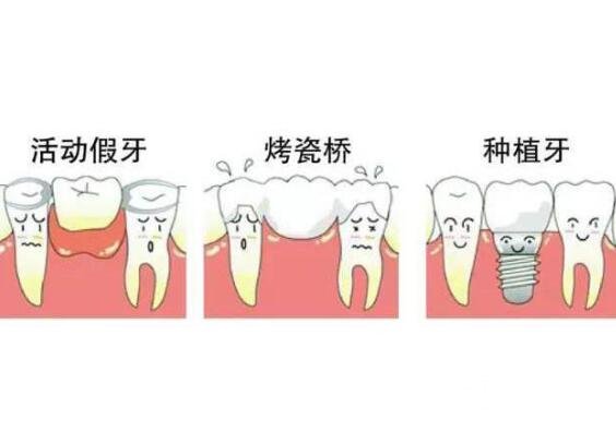 门牙镶牙过程图解图片