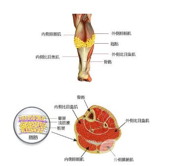 小腿脂肪分布图片