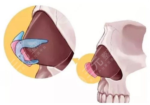 鼻翼沟成形手术图解图片