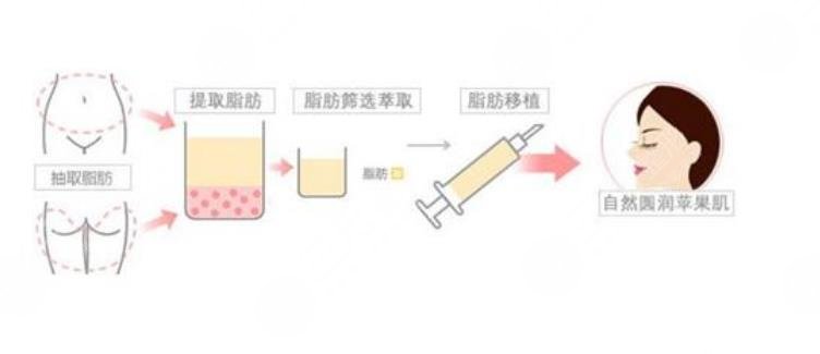 苹果肌填充的费用大概要多少钱呢?