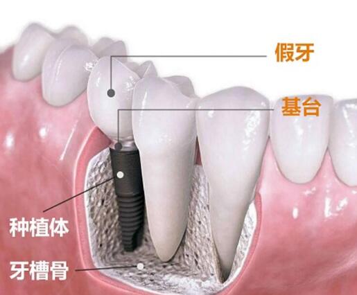 牙齿需要怎么种植的