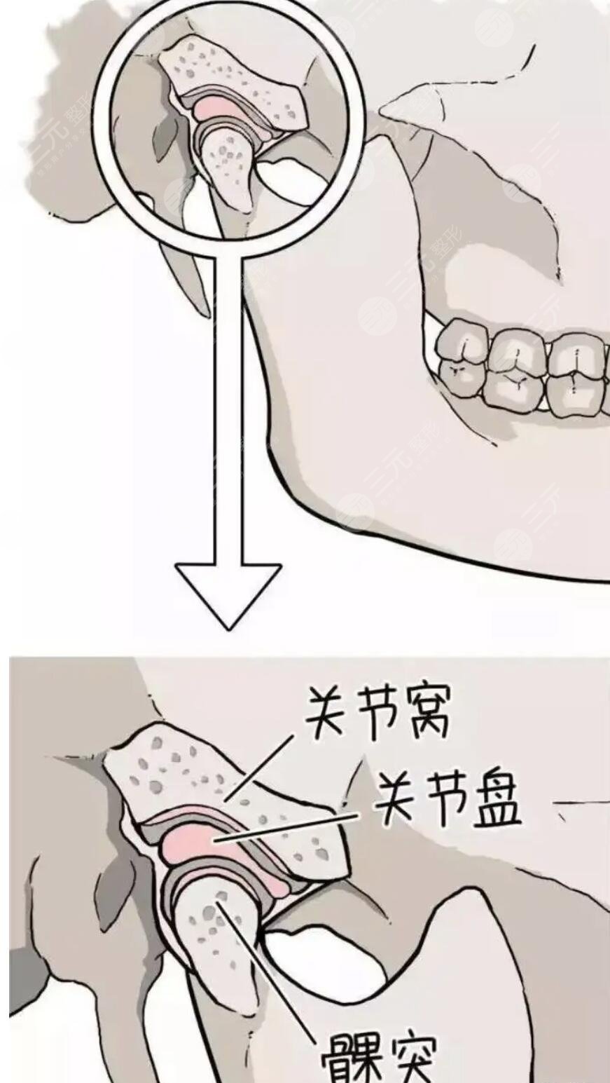 下颚骨太宽做手术多少钱