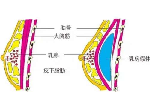 中山假体乳房再造前10强医院公布！可以收藏起